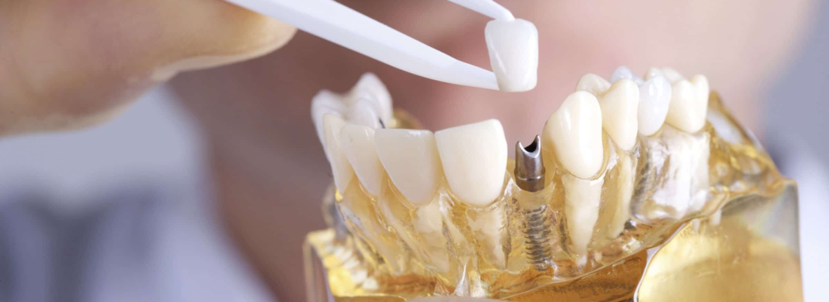Do I Have To Replace My Extracted Tooth?