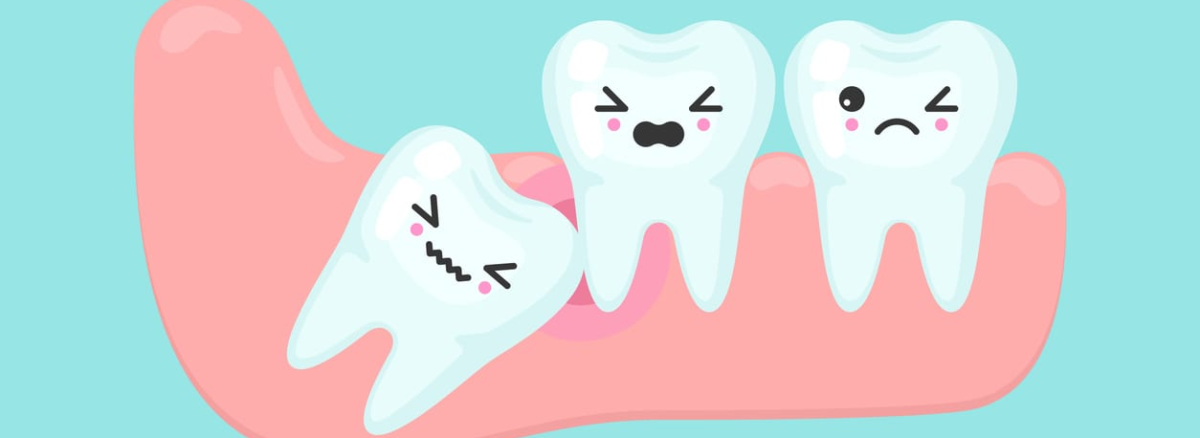 What To Expect When Getting Your Wisdom Tooth Removed?