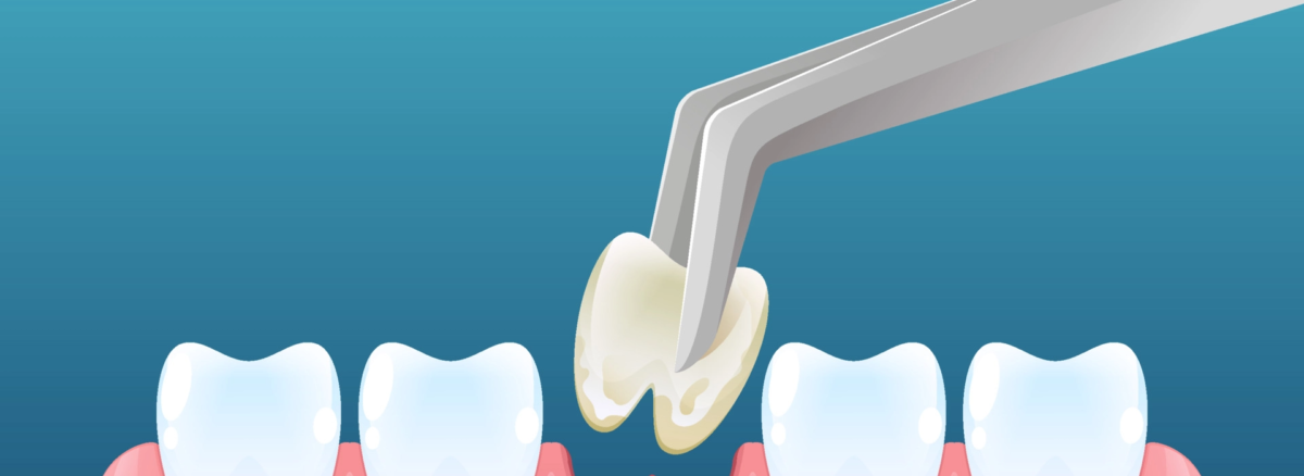 Tooth Extraction by Gupta Dental Care