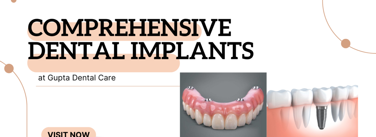 dental implants