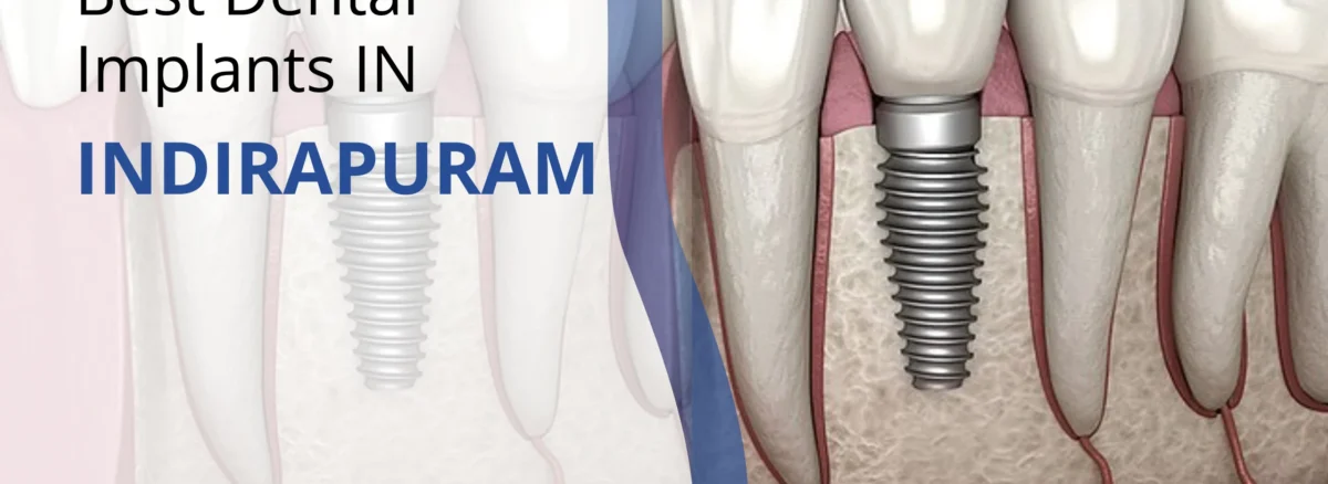 Best Dental Implant Clinic in Indirapuram