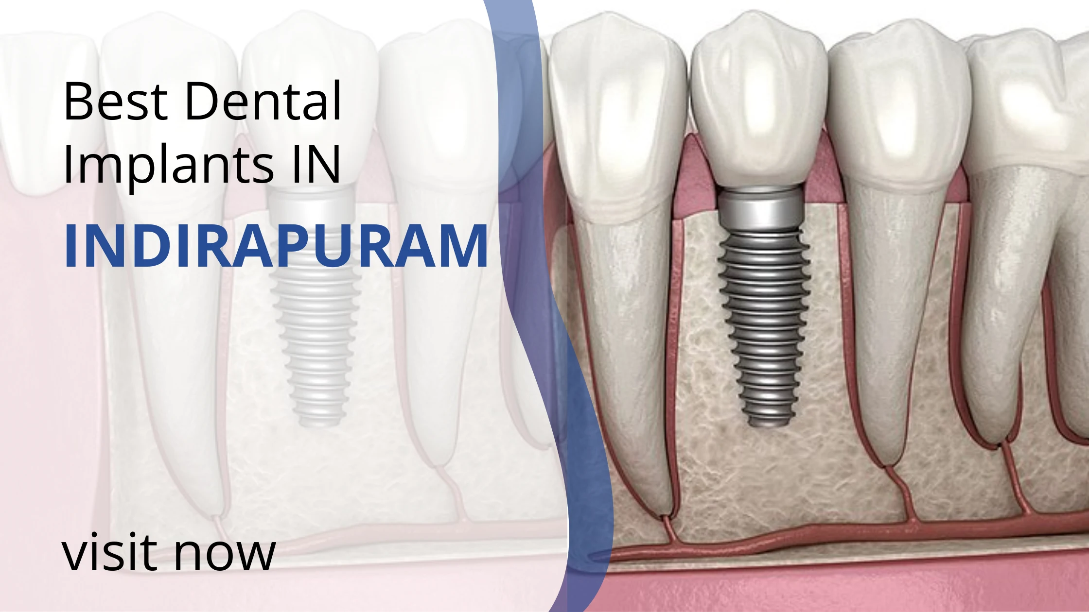 Best Dental Implant Clinic in Indirapuram