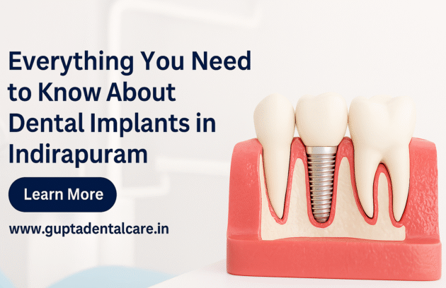 Implant Clinic in Indirapuram
