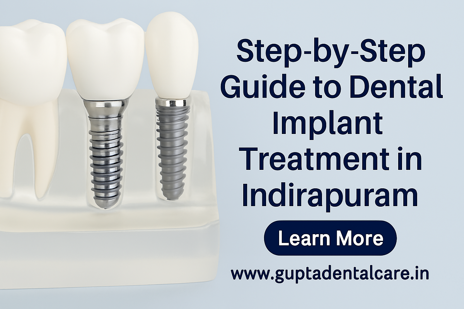 Implant Clinic in Indirapuram